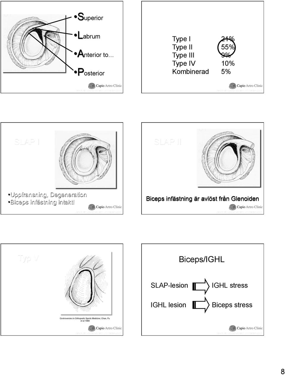 Biceps infästning är avlöst från Glenoiden Typ V Biceps/IGHL SLAP-lesion IGHL stress