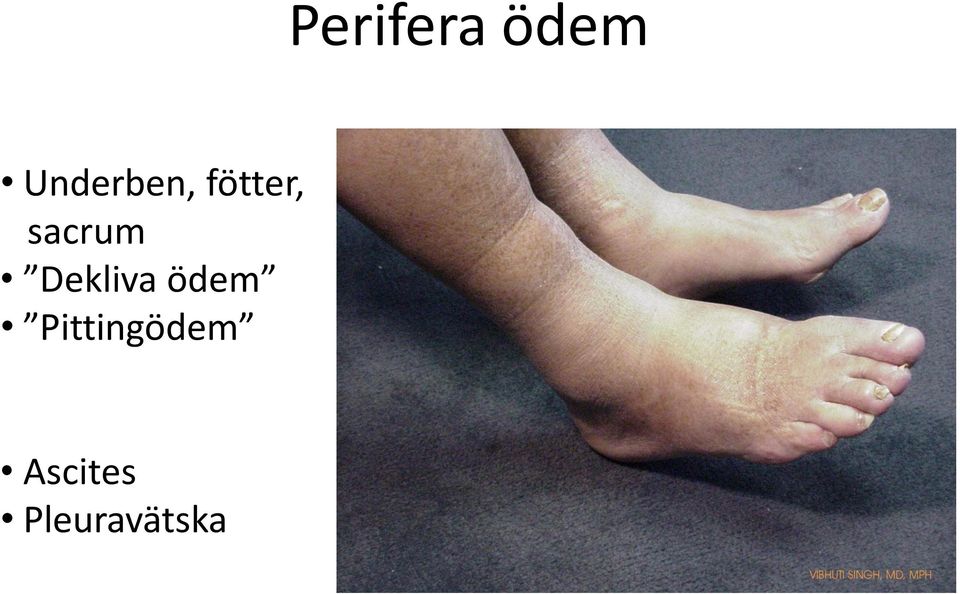 sacrum Dekliva ödem