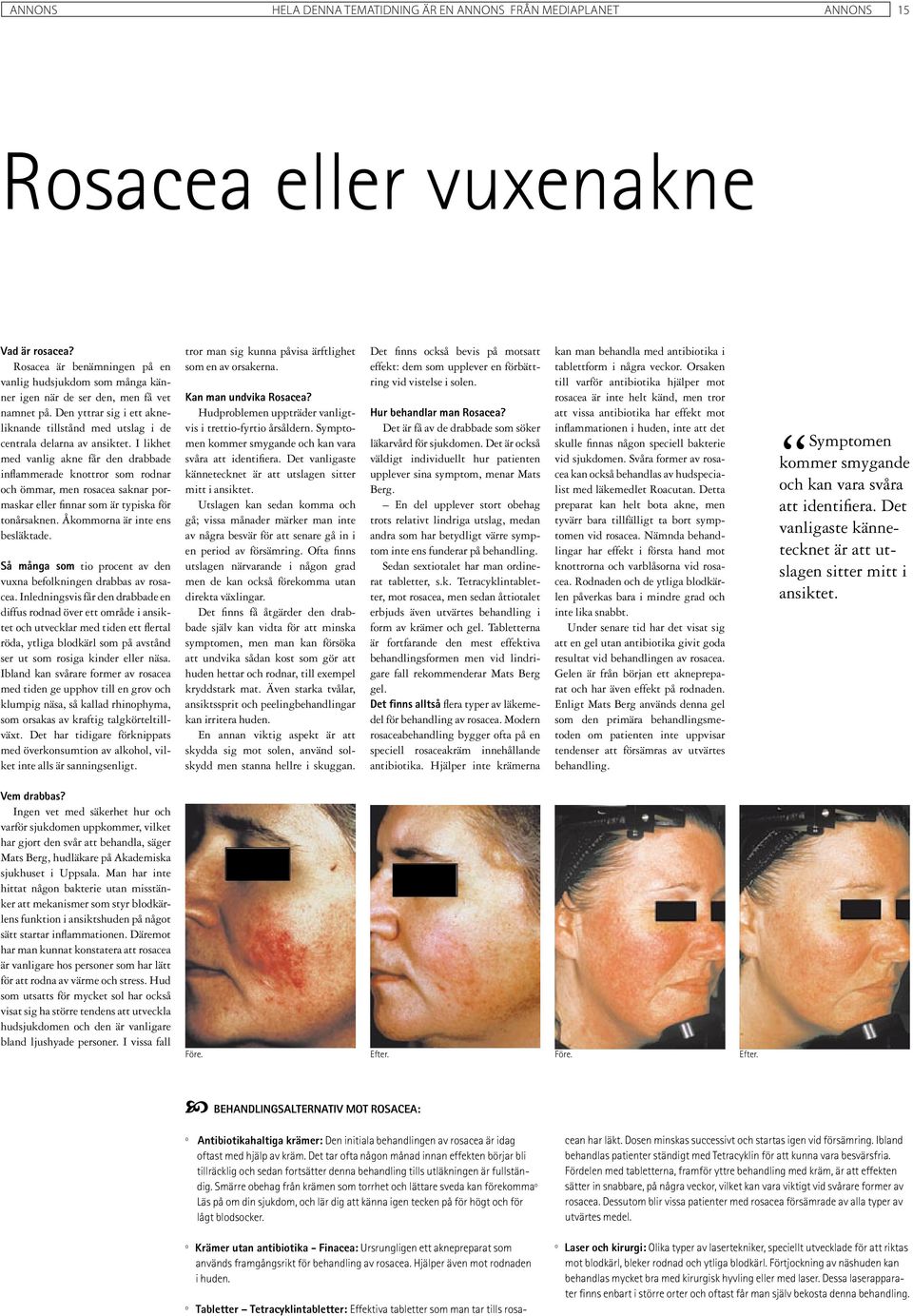 I likhet med vanlig akne får den drabbade inflammerade knottror som rodnar och ömmar, men rosacea saknar pormaskar eller finnar som är typiska för tonårsaknen. Åkommorna är inte ens besläktade.