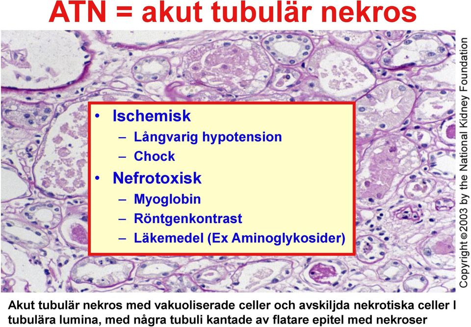 Akut tubulär nekros med vakuoliserade celler och avskiljda nekrotiska