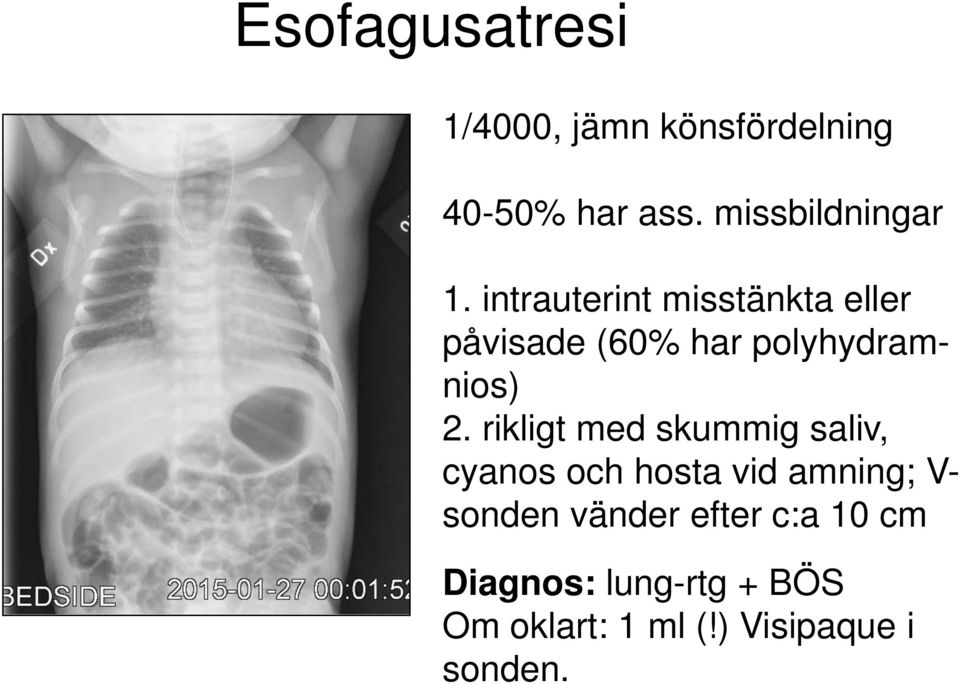 intrauterint misstänkta eller påvisade (60% har polyhydramnios) 2.