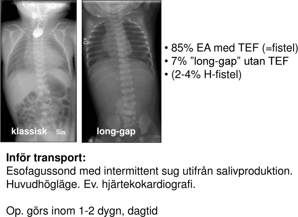 Esofagussond med intermittent sug utifrån