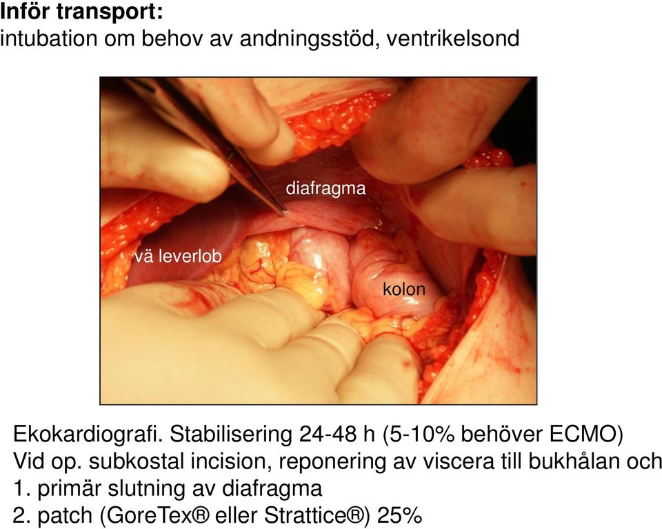 Stabilisering 24-48 h (5-10% behöver ECMO) Vid op.