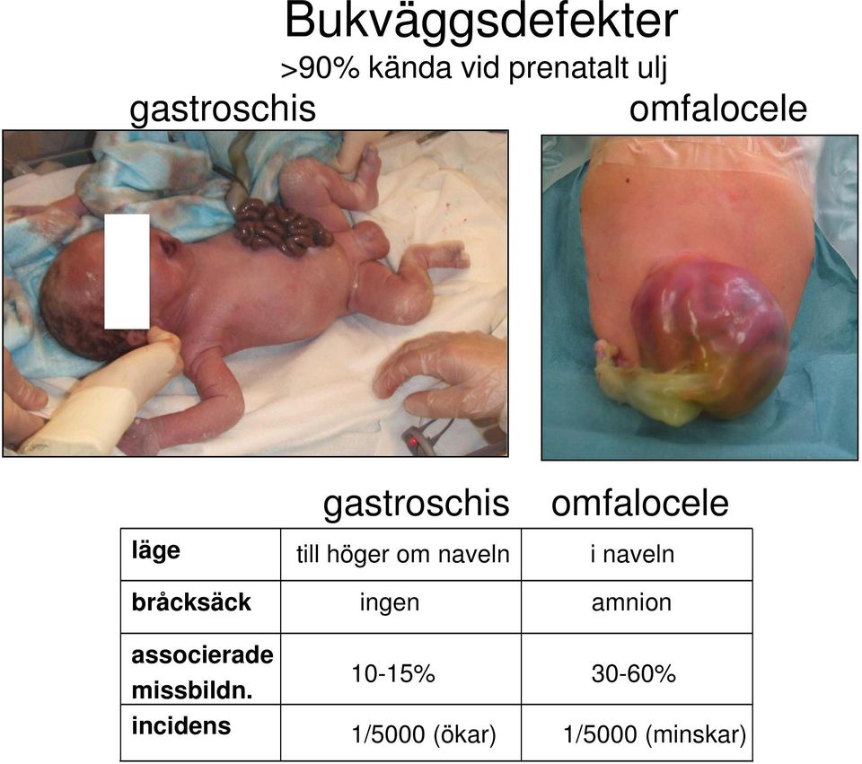 incidens gastroschis till höger om naveln ingen 10-15%