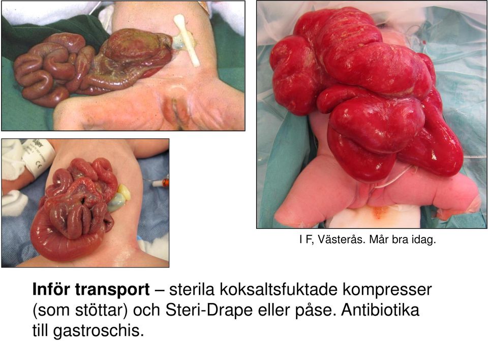 koksaltsfuktade kompresser (som