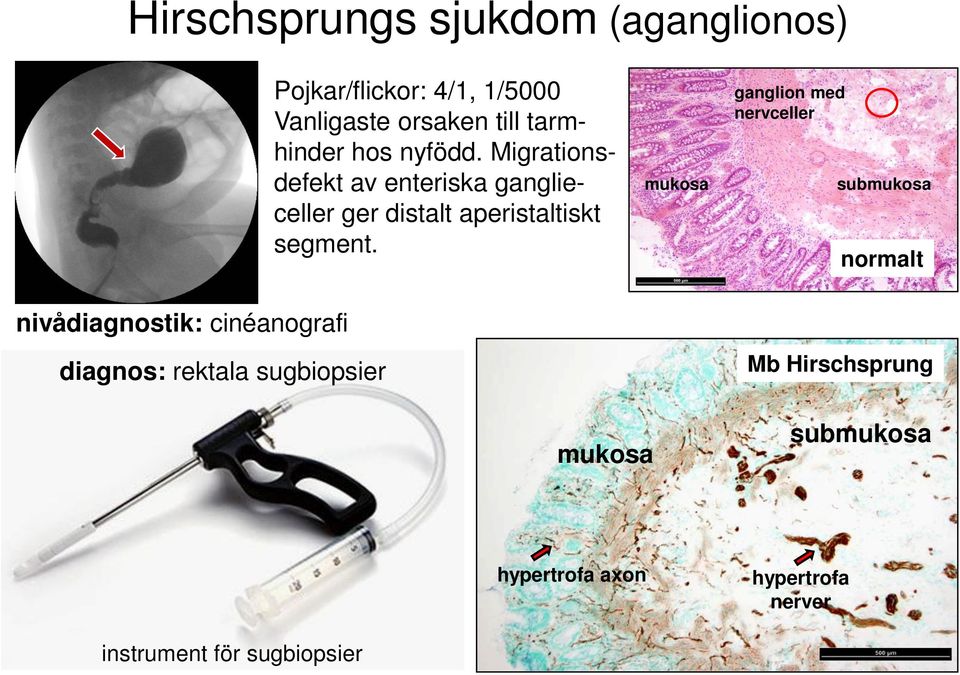 Migrationsdefekt av enteriska ganglieceller ger distalt aperistaltiskt segment.