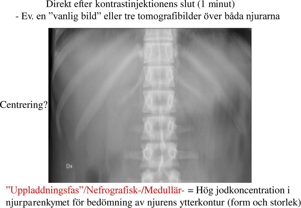 Tomografisnitt 6 cm Uppladdningsfas /Nefrografisk-/Medullär- = Hög