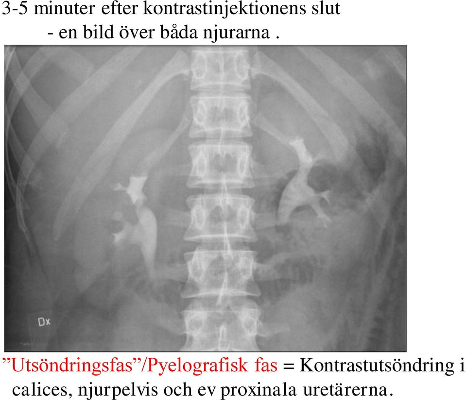 Utsöndringsfas /Pyelografisk fas =