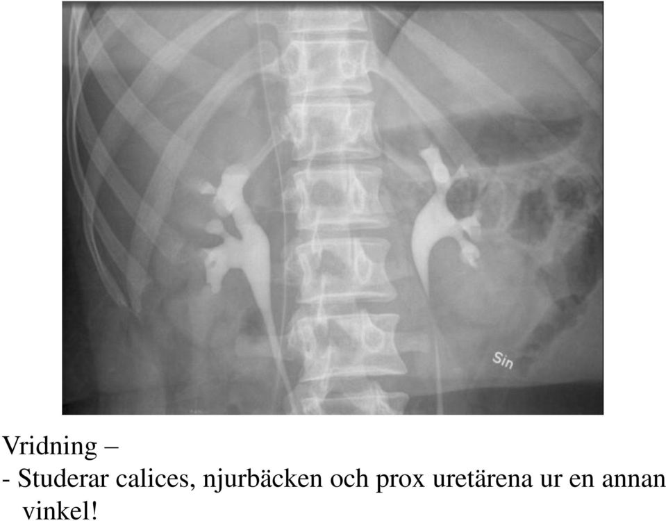 calices, njurbäcken och