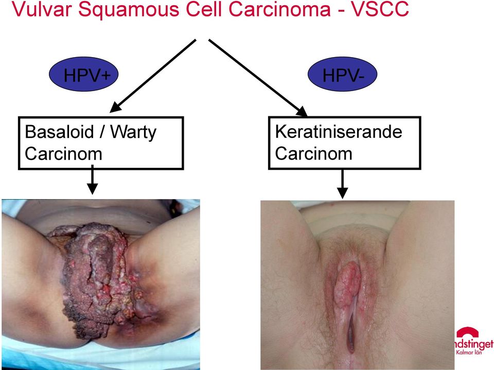 HPV- Basaloid / Warty