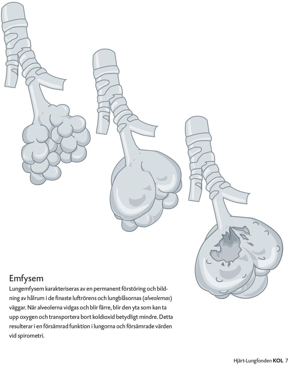 När alveolerna vidgas och blir färre, blir den yta som kan ta upp oxygen och transportera bort