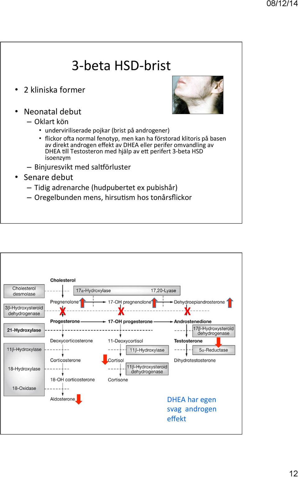 DHEA 2ll Testosteron med hjälp av ef perifert 3- beta HSD isoenzym Binjuresvikt med saliörluster Senare debut Tidig