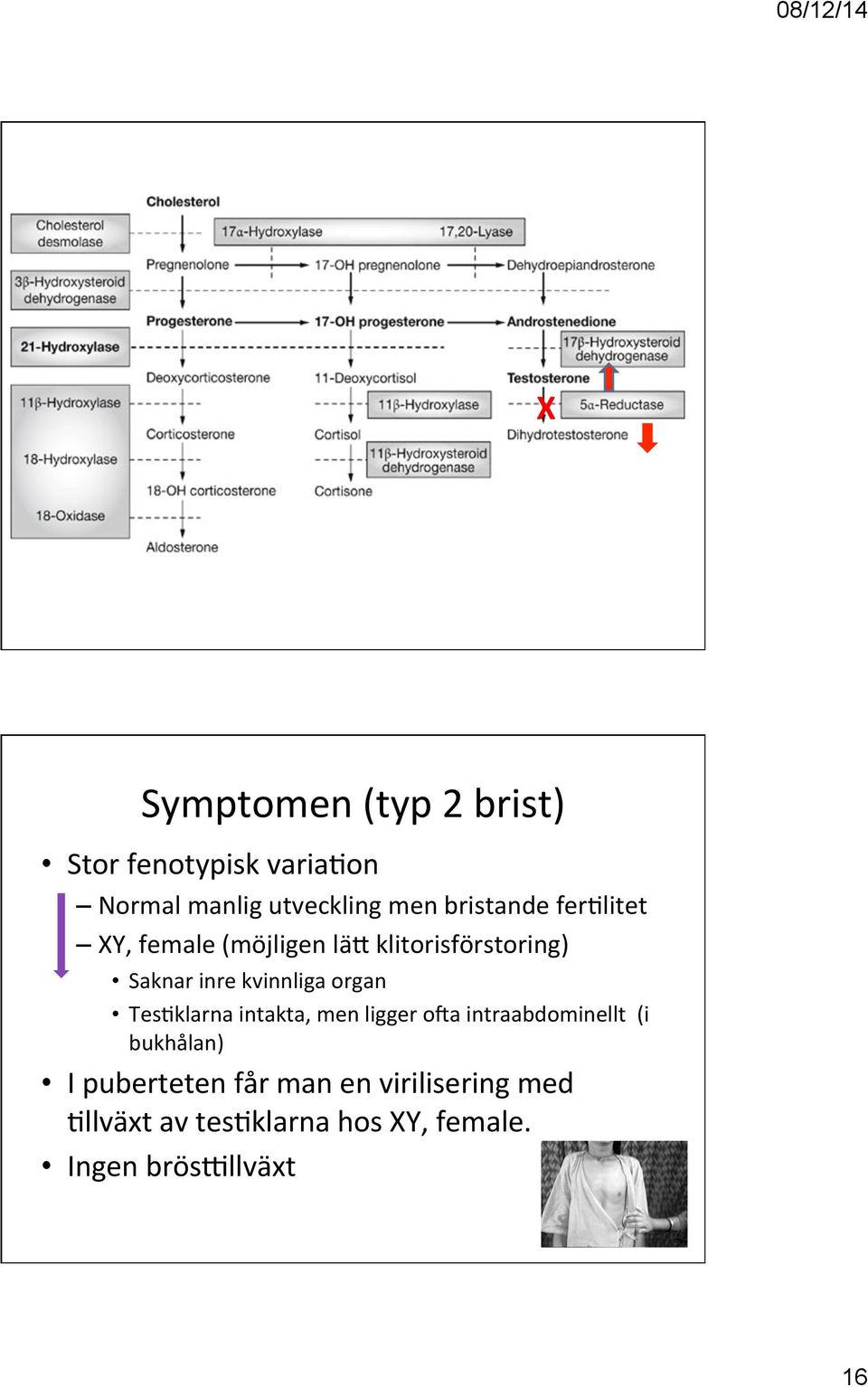 kvinnliga organ Tes2klarna intakta, men ligger ova intraabdominellt (i bukhålan) I