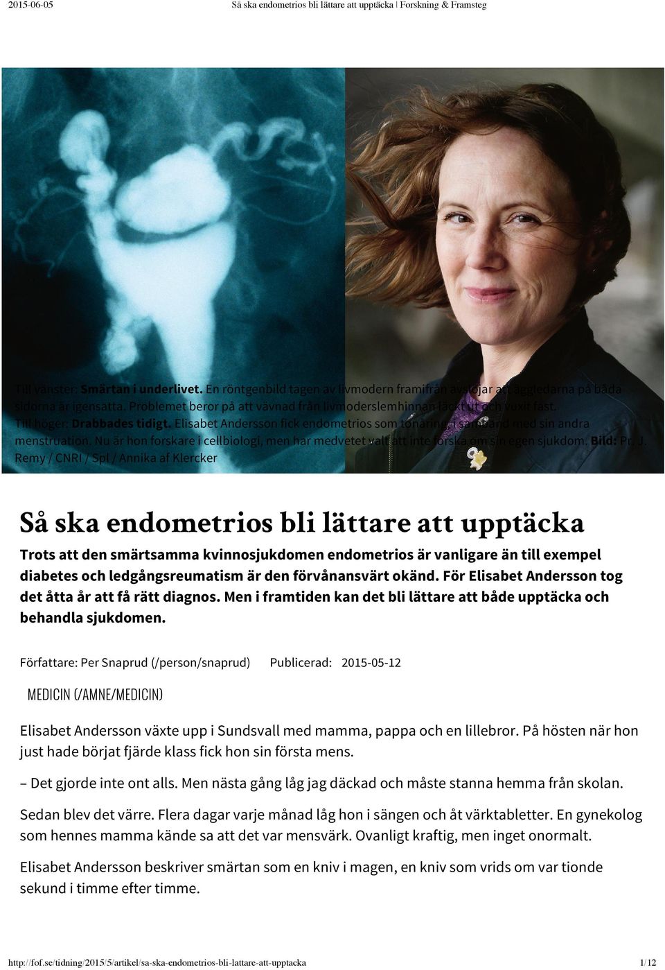 Till höger: Drabbades tidigt. Elisabet Andersson fick endometrios som tonåring, i samband med sin andra menstruation.