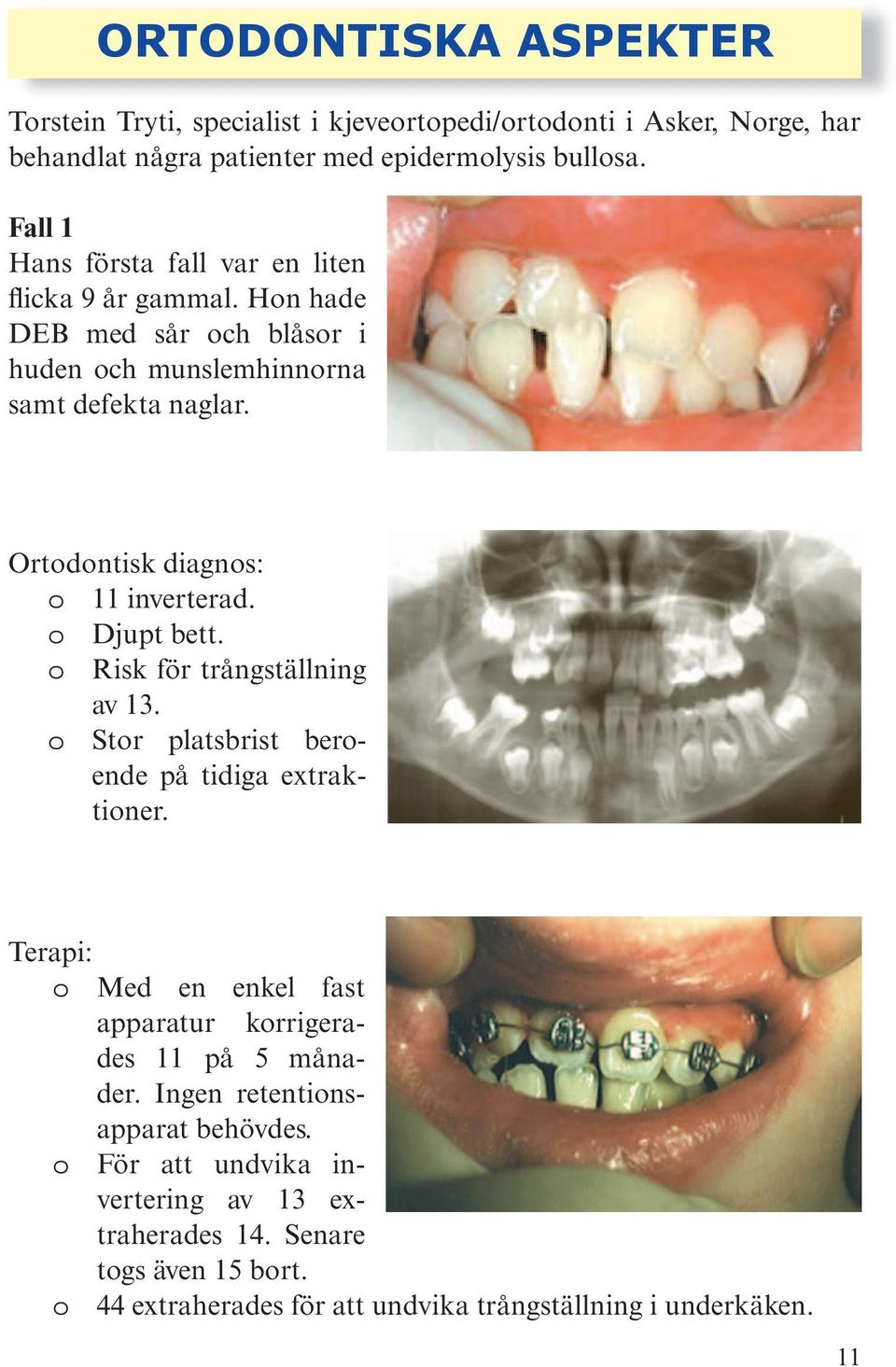 Ortodontisk diagnos: o 11 inverterad. o Djupt bett. o Risk för trångställning av 13. o Stor platsbrist beroende på tidiga extraktioner.