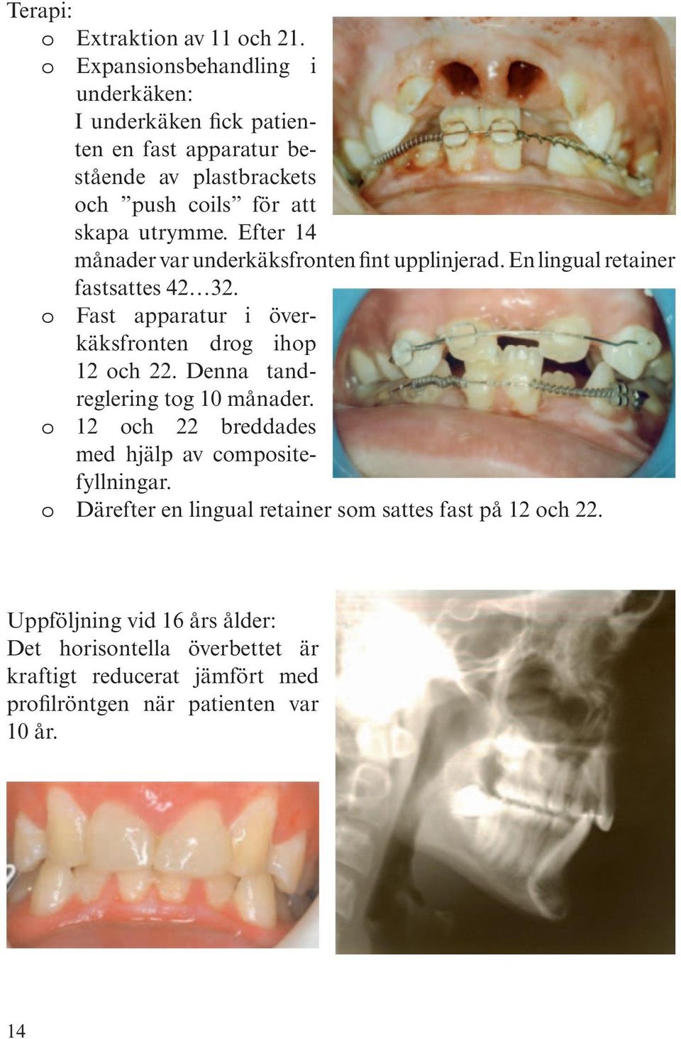 Efter 14 månader var underkäksfronten fint upplinjerad. En lingual retainer fastsattes 42 32. o Fast apparatur i överkäksfronten drog ihop 12 och 22.