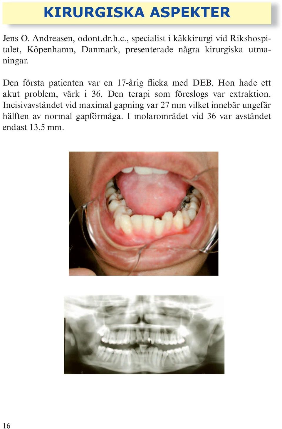 Den första patienten var en 17-årig flicka med DEB. Hon hade ett akut problem, värk i 36.