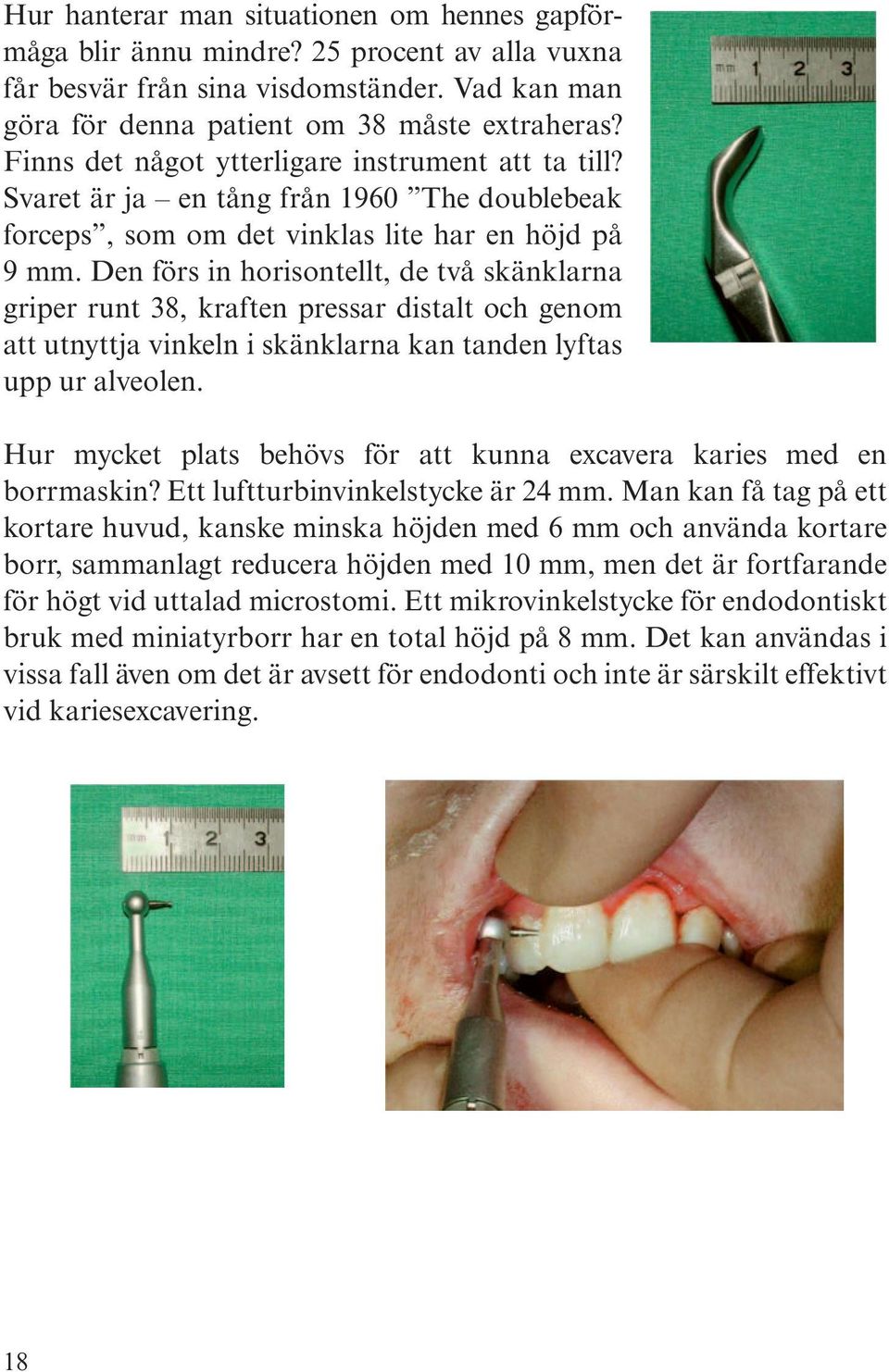 Den förs in horisontellt, de två skänklarna griper runt 38, kraften pressar distalt och genom att utnyttja vinkeln i skänklarna kan tanden lyftas upp ur alveolen.