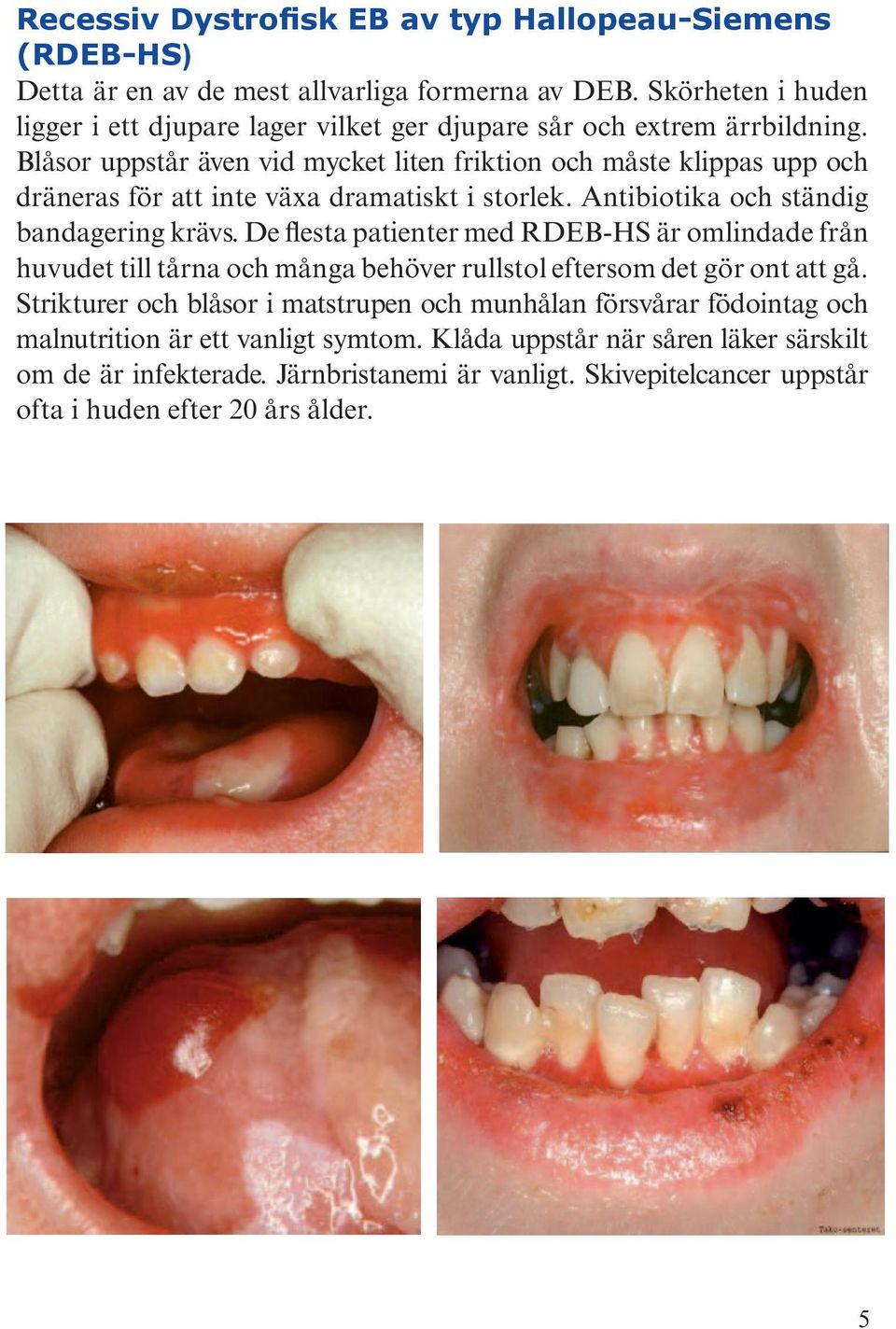 Blåsor uppstår även vid mycket liten friktion och måste klippas upp och dräneras för att inte växa dramatiskt i storlek. Antibiotika och ständig bandagering krävs.