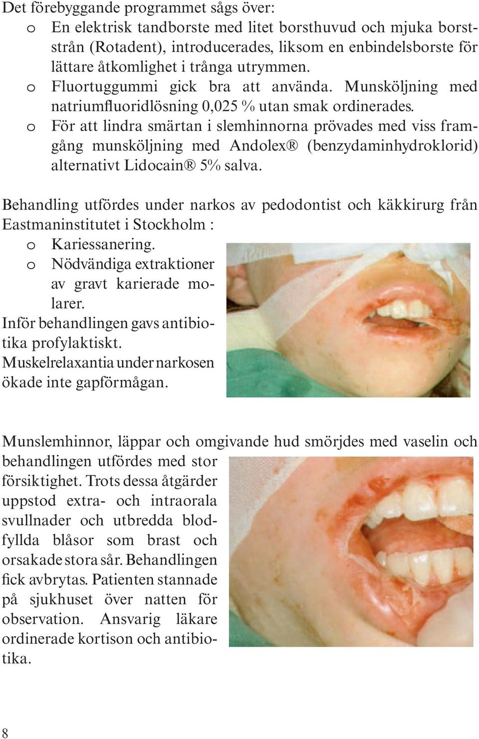 o För att lindra smärtan i slemhinnorna prövades med viss framgång munsköljning med Andolex (benzydaminhydroklorid) alter na tivt Lidocain 5% salva.