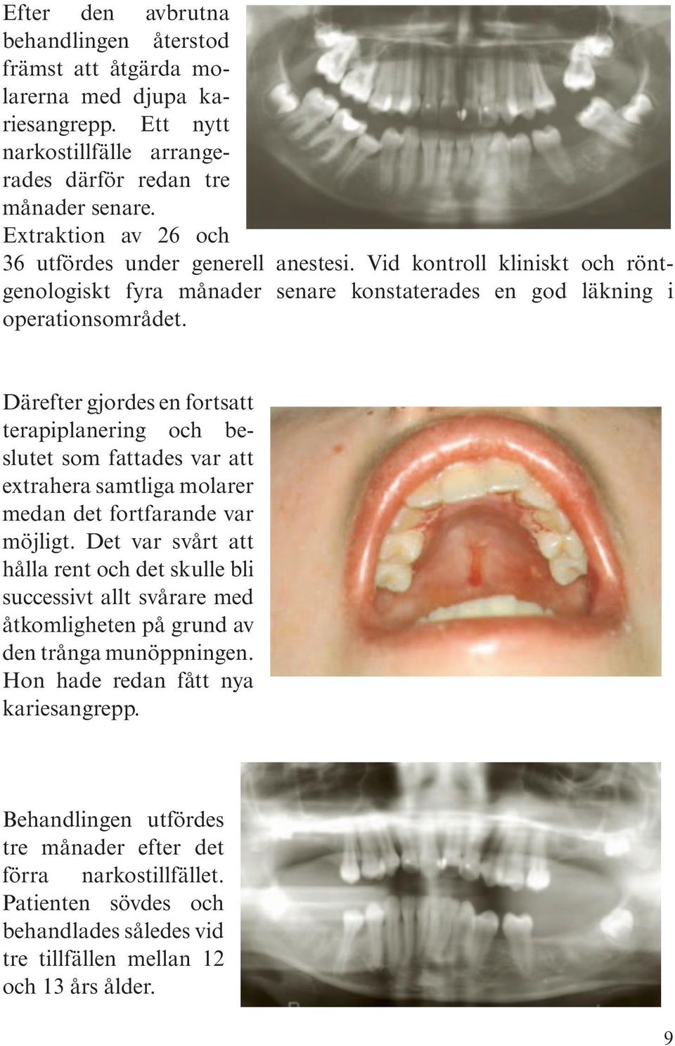 Därefter gjordes en fortsatt terapiplanering och beslutet som fattades var att extrahera samtliga molarer medan det fortfarande var möjligt.