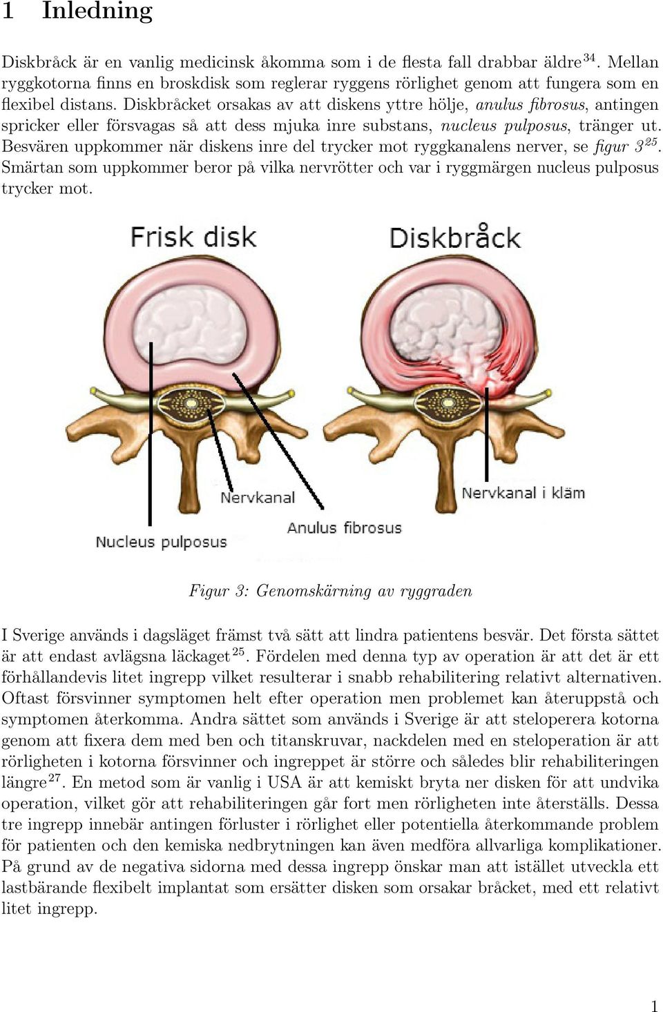 Diskbråcket orsakas av att diskens yttre hölje, anulus fibrosus, antingen spricker eller försvagas så att dess mjuka inre substans, nucleus pulposus, tränger ut.