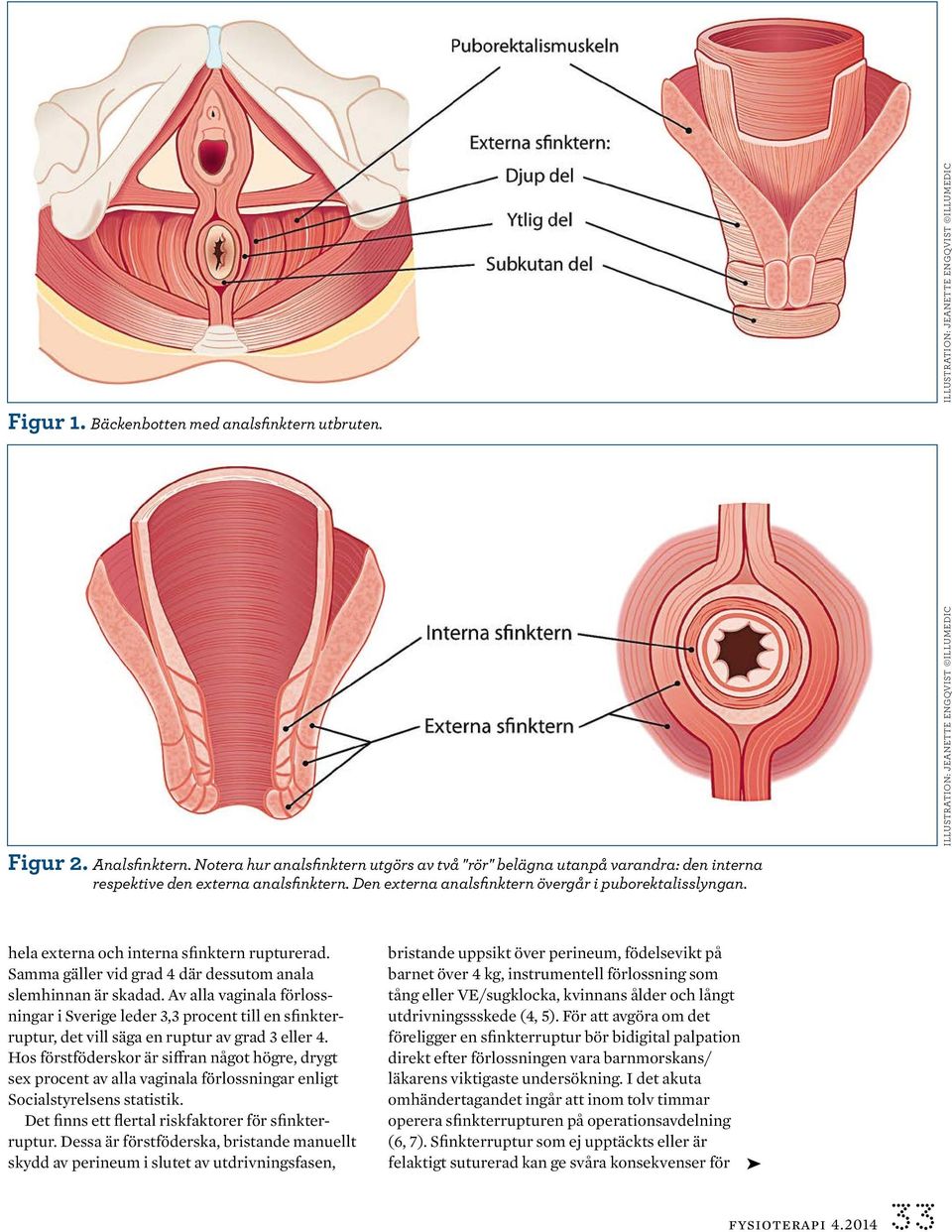 Illustration: jeanette engqvist illumedic hela externa och interna sfinktern rupturerad. Samma gäller vid grad 4 där dessutom anala slemhinnan är skadad.