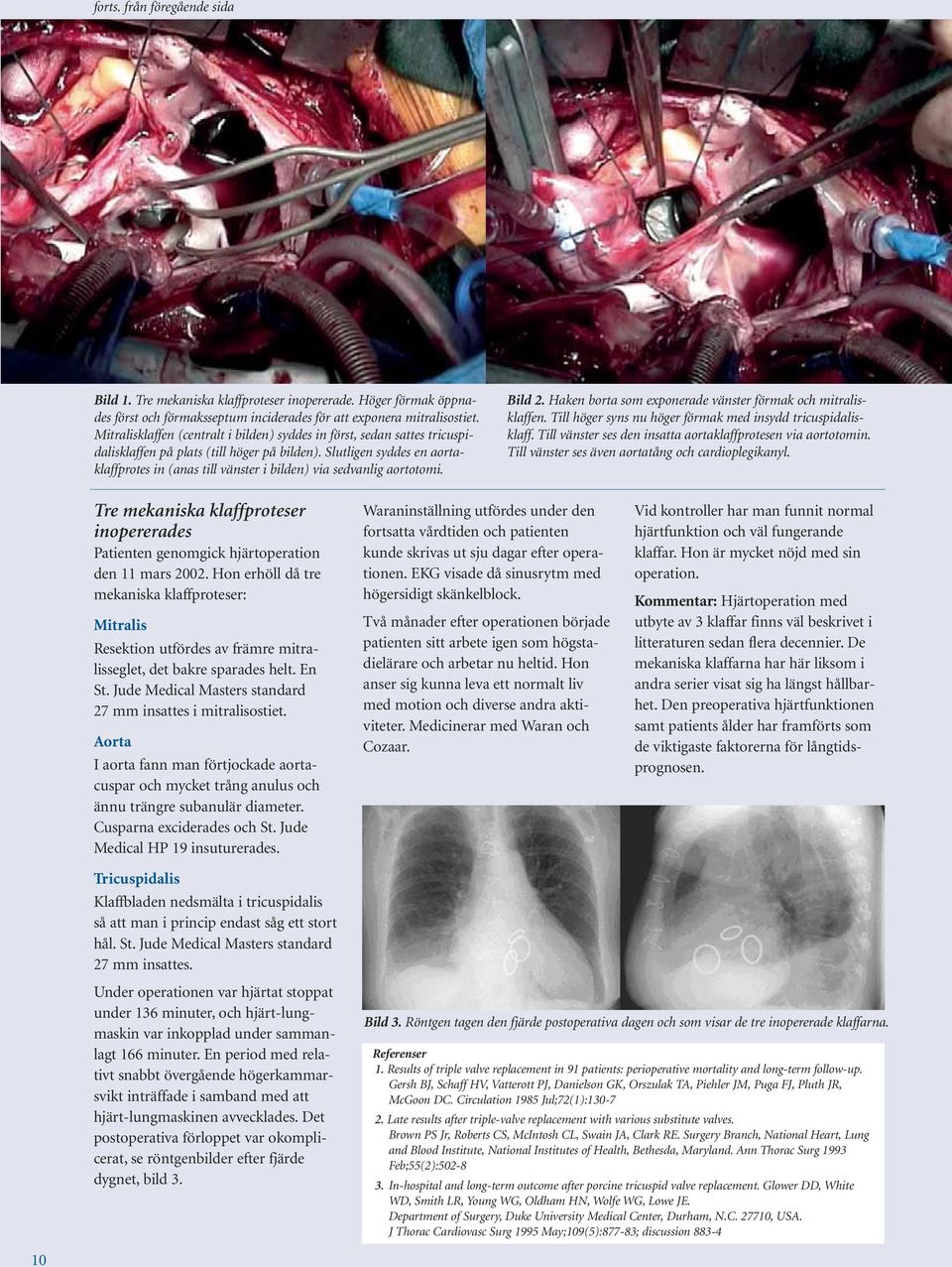 Slutligen syddes en aortaklaffprotes in (anas till vänster i bilden) via sedvanlig aortotomi. Bild 2. Haken borta som exponerade vänster förmak och mitralisklaffen.