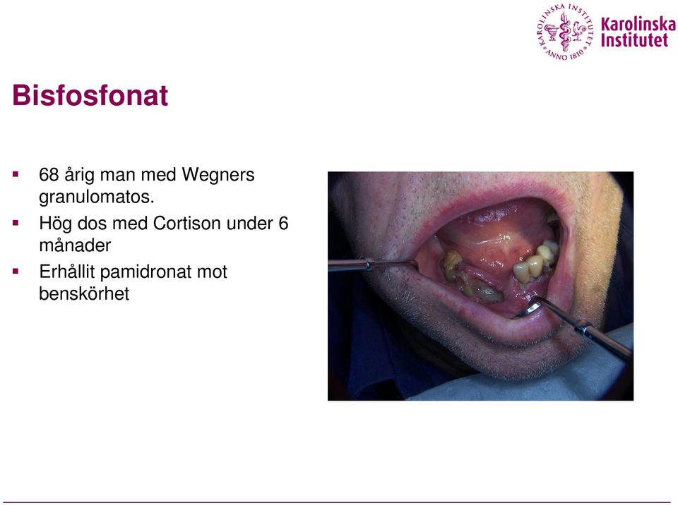 Hög dos med Cortison under 6