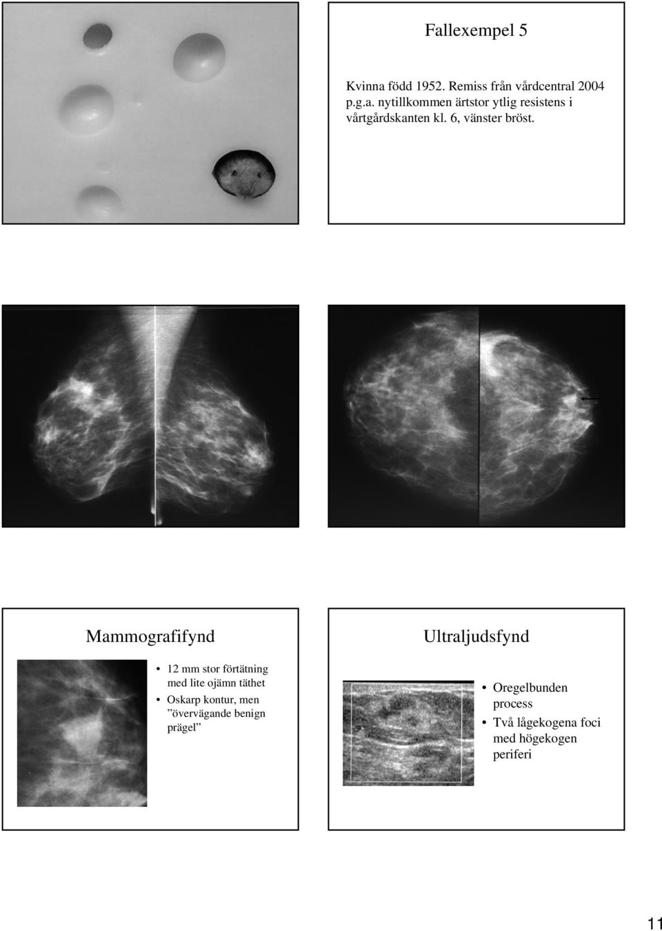 Mammografifynd 12 mm stor förtätning med lite ojämn täthet Oskarp kontur, men