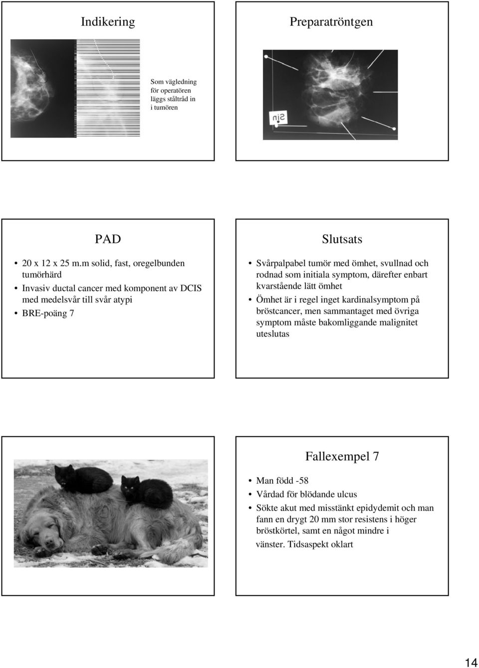 svullnad och rodnad som initiala symptom, därefter enbart kvarstående lätt ömhet Ömhet är i regel inget kardinalsymptom på bröstcancer, men sammantaget med övriga symptom