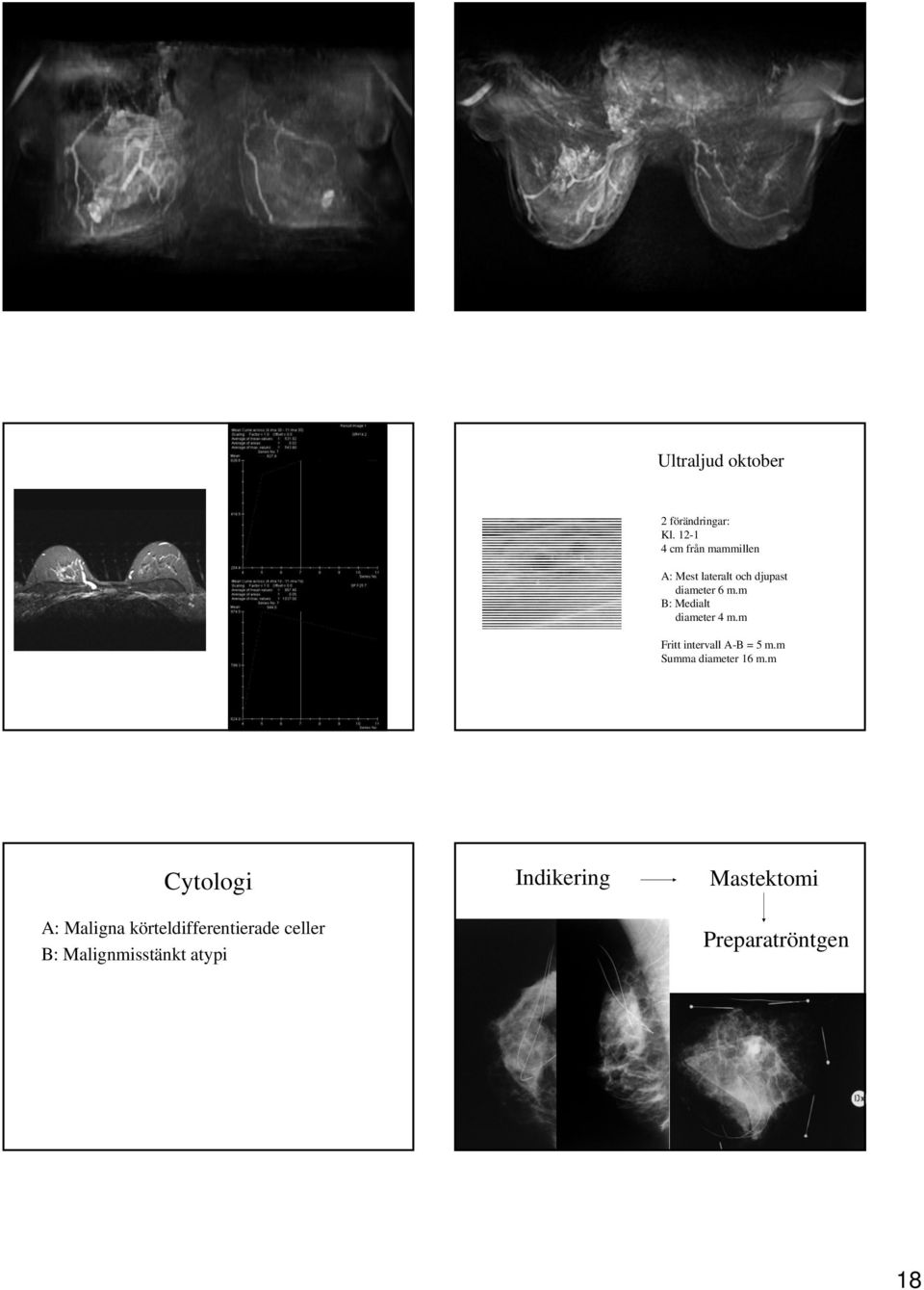 m B: Medialt diameter 4 m.m Fritt intervall A-B = 5 m.m Summa diameter 16 m.