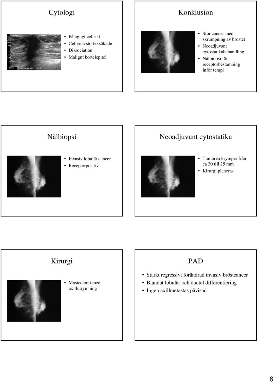 Invasiv lobulär cancer Receptorpositiv Tumören krymper från ca 30 till 25 mm Kirurgi planeras Kirurgi Mastectomi med