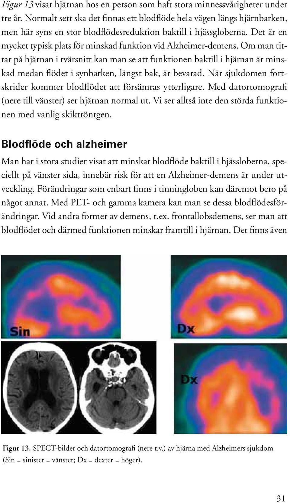 Det är en mycket typisk plats för minskad funktion vid Alzheimer-demens.