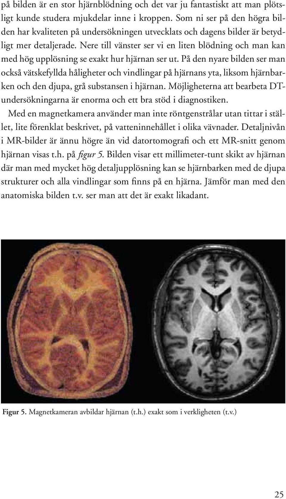 Nere till vänster ser vi en liten blödning och man kan med hög upplösning se exakt hur hjärnan ser ut.