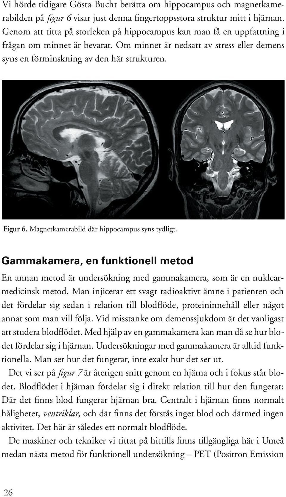 Magnetkamerabild där hippocampus syns tydligt. Gammakamera, en funktionell metod En annan metod är undersökning med gammakamera, som är en nuklearmedicinsk metod.