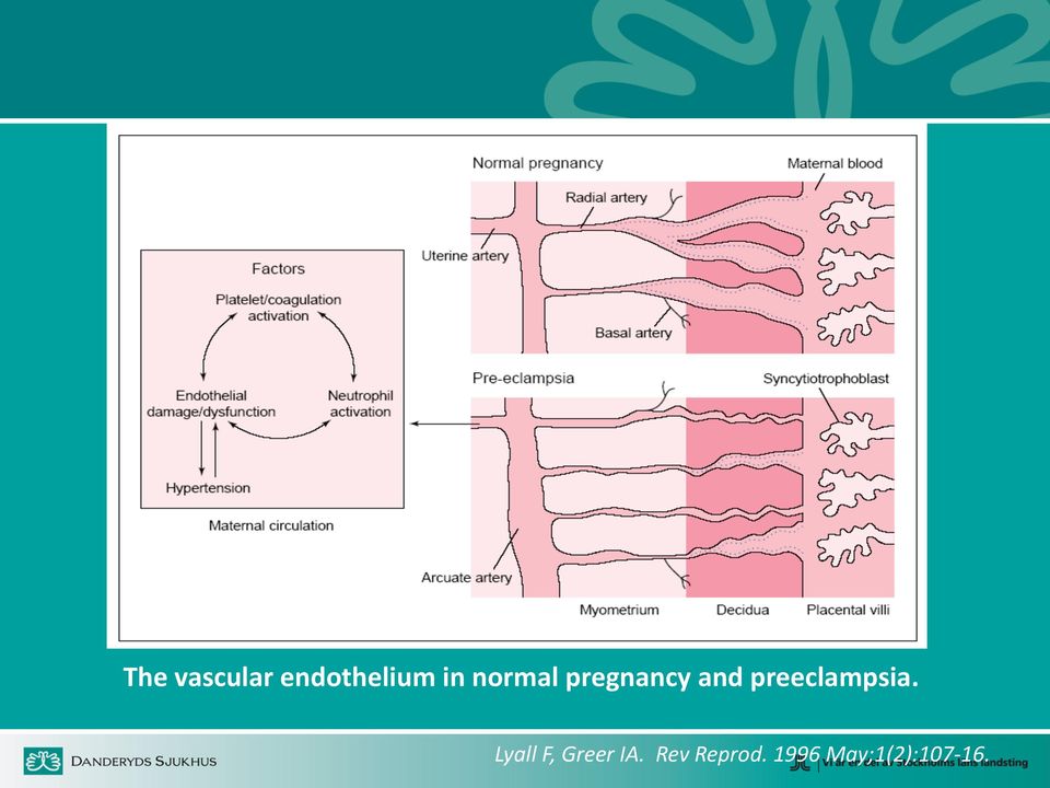 preeclampsia.