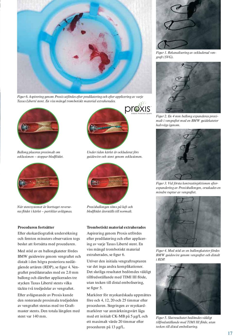 Ballong placeras proximalt om ocklusionen stoppar blodflödet. Under tiden kärlet är ockluderat förs guidewire och stent genom ocklusionen. Figur 3.