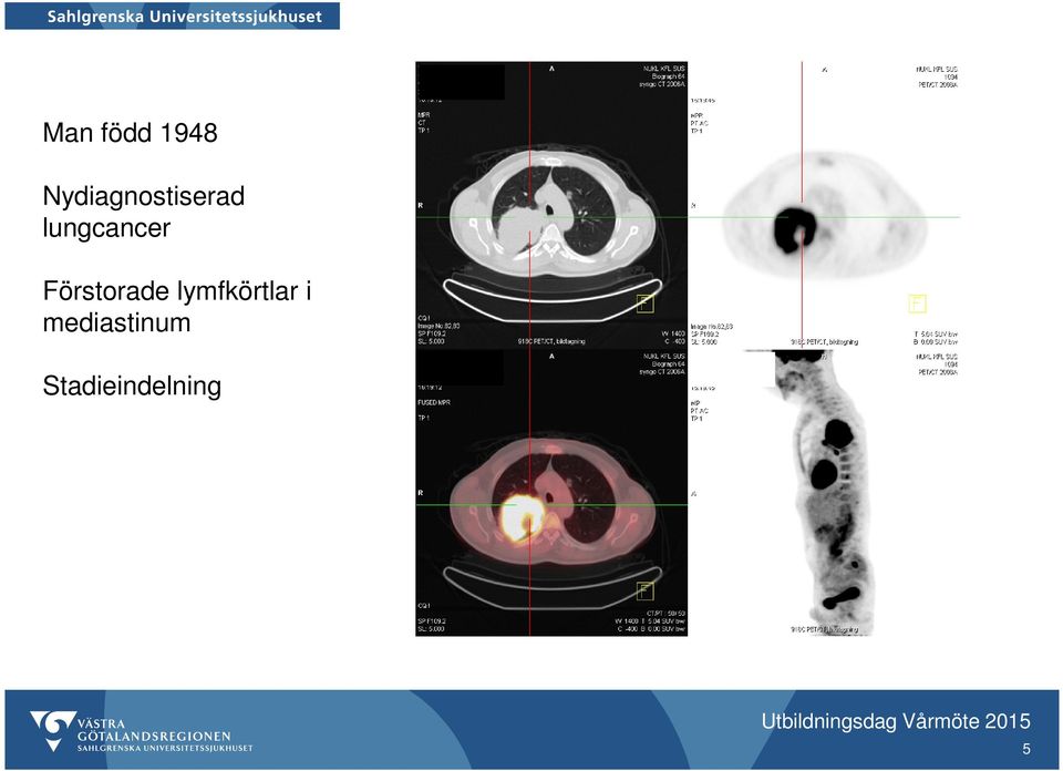 lymfkörtlar i mediastinum