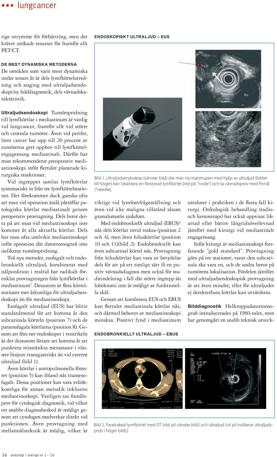 vävnadskaraktäristik. Ultraljudsendoskopi Tumörspridning till lymfkörtlar i mediastinum är vanlig vid lungcancer, framför allt vid större och centrala tumörer.