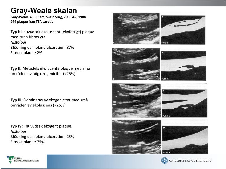 ulceration 87% Fibröst plaque 2% Typ II: Metadels ekolucenta plaque med små områden av hög ekogenicitet (<25%).