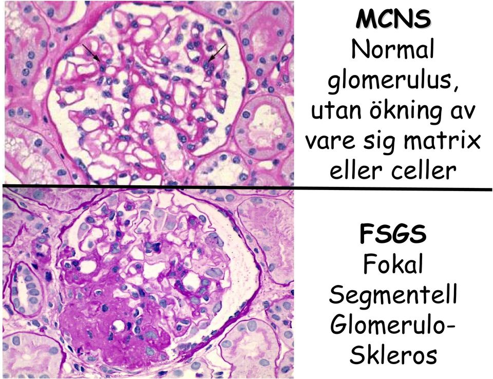 eller celler FSGS Fokal