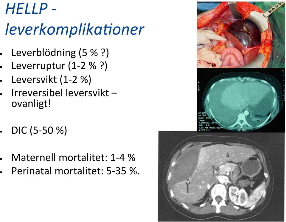 ) Leversvikt (1-2 %) Irreversibel leversvikt