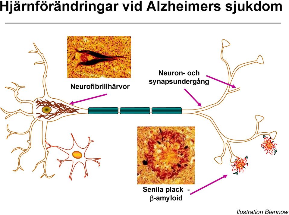 Neurofibrillhärvor Neuron- och