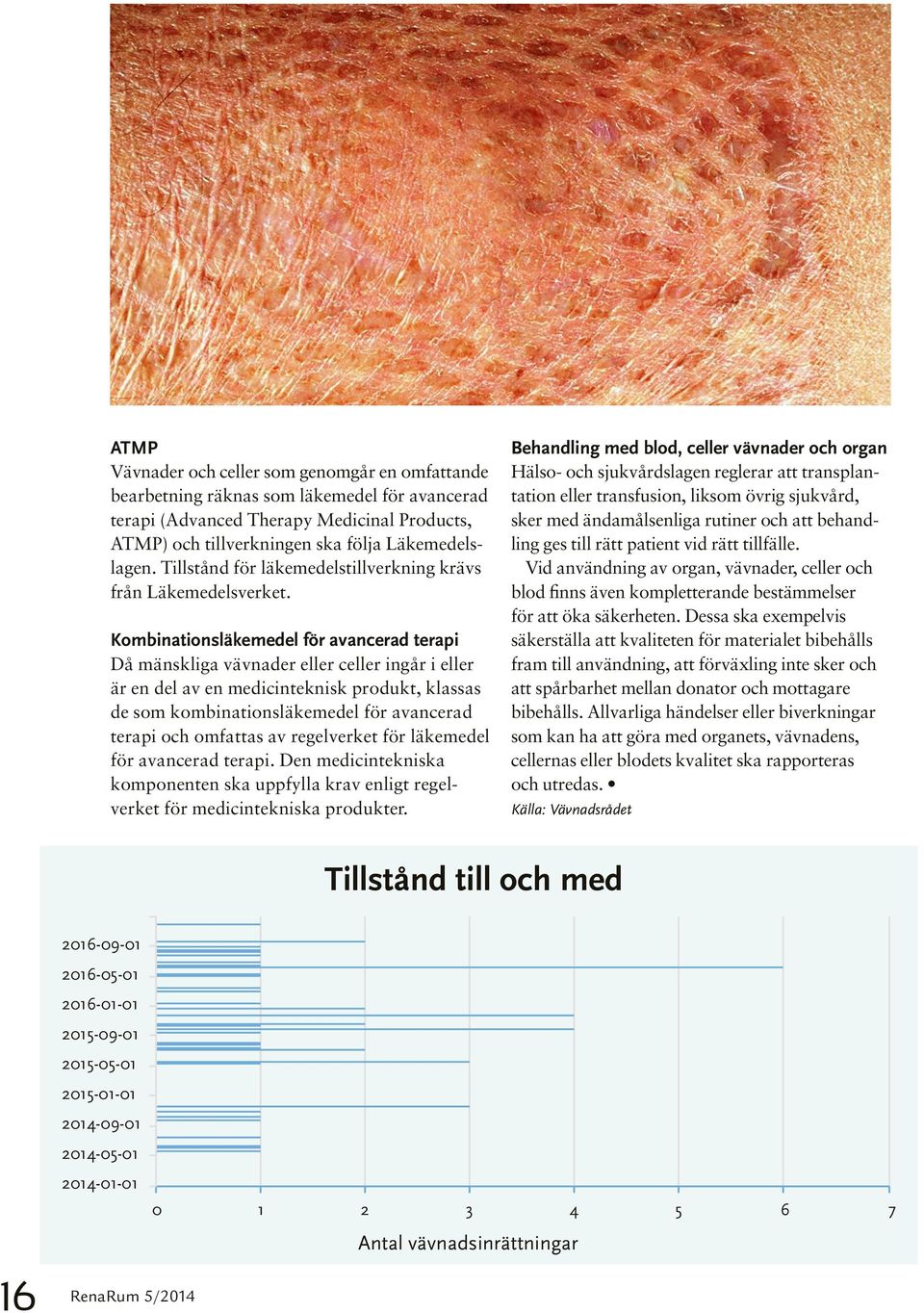 Kombinationsläkemedel för avancerad terapi Då mänskliga vävnader eller celler ingår i eller är en del av en medicinteknisk produkt, klassas de som kombinationsläkemedel för avancerad terapi och