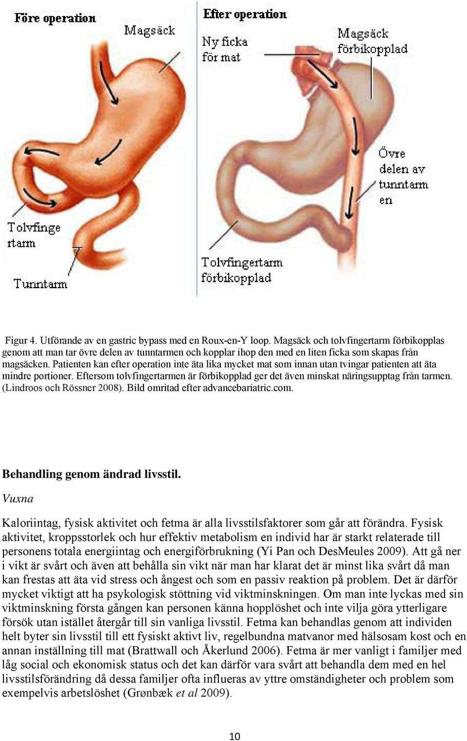 Patienten kan efter operation inte äta lika mycket mat som innan utan tvingar patienten att äta mindre portioner.