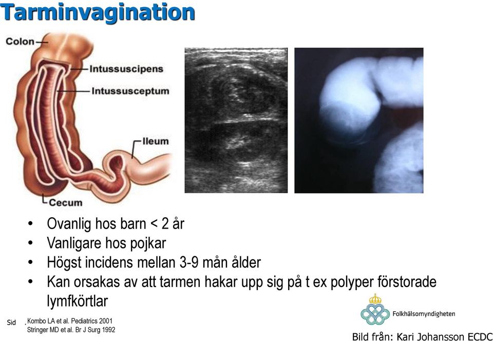 sig på t ex polyper förstorade lymfkörtlar Kombo LA et al