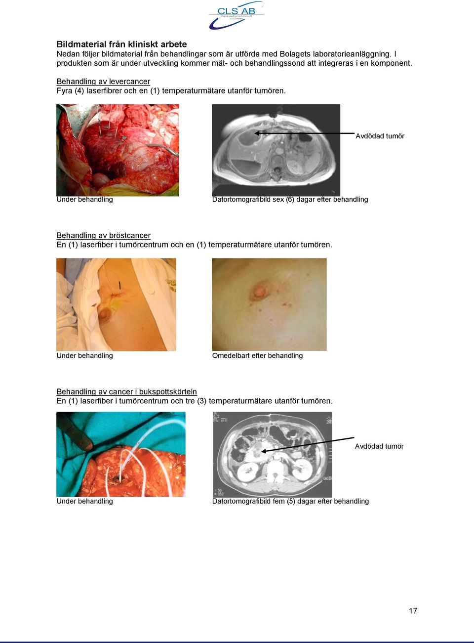 Behandling av levercancer Fyra (4) laserfibrer och en (1) temperaturmätare utanför tumören.