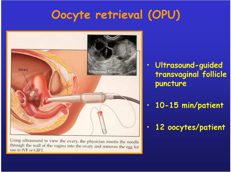 transvaginal follicle