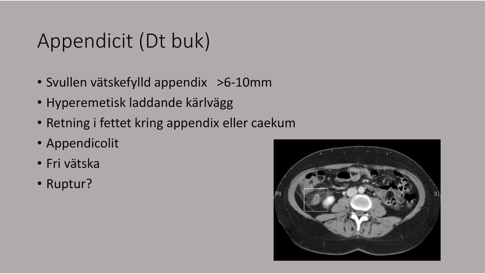 kärlvägg Retning i fettet kring appendix